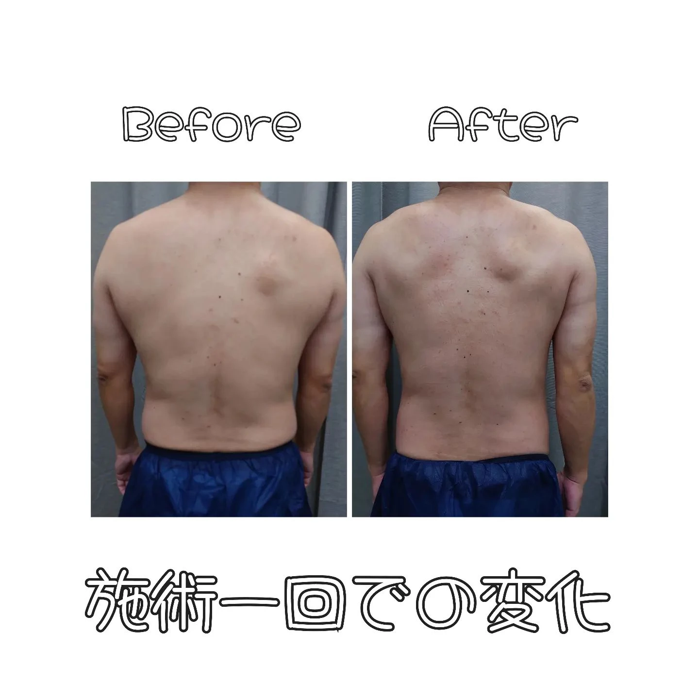 【フォースカッター施術一回での変化】
