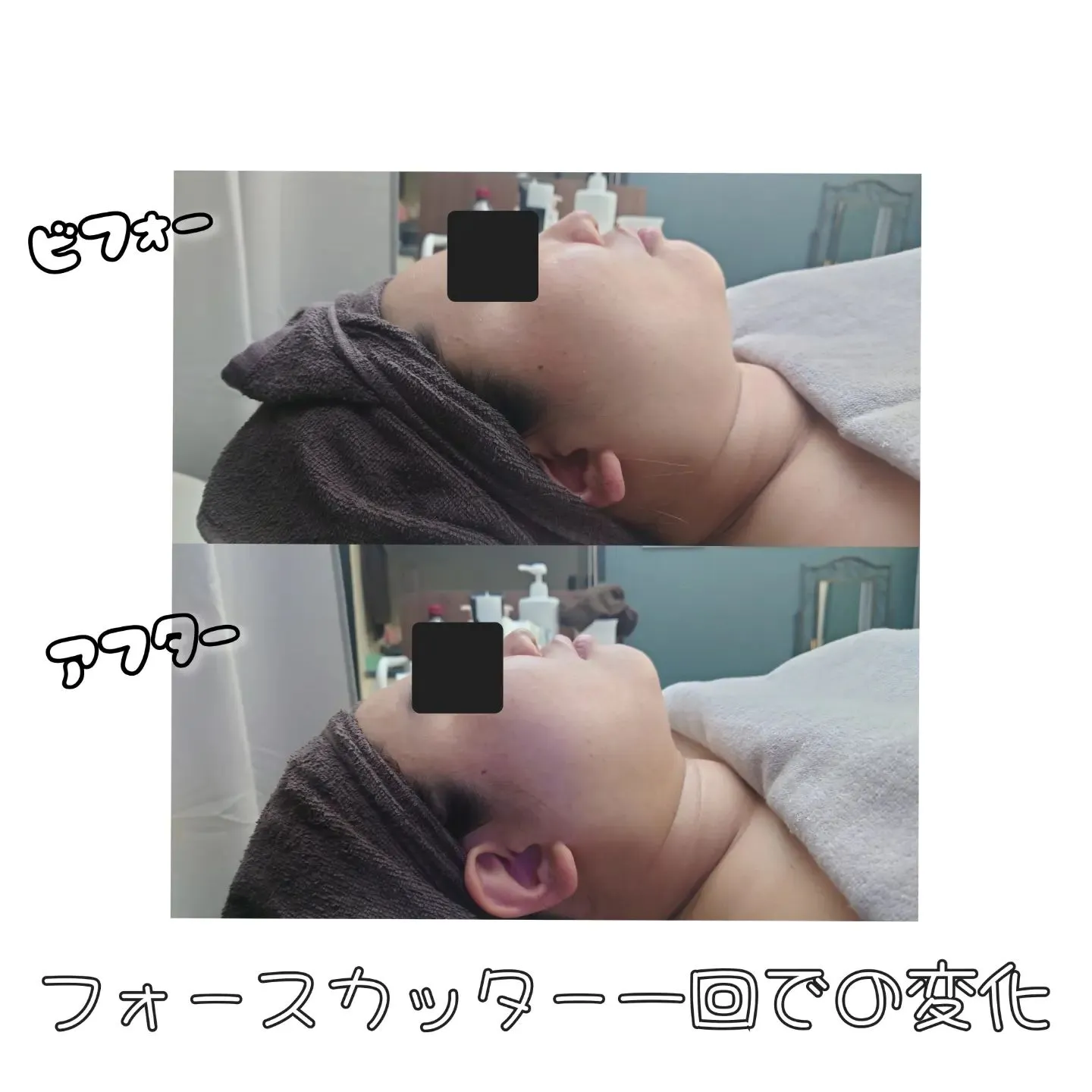 【フォースカッターフェイシャル✨】新宿の痩身ならエステサロ...