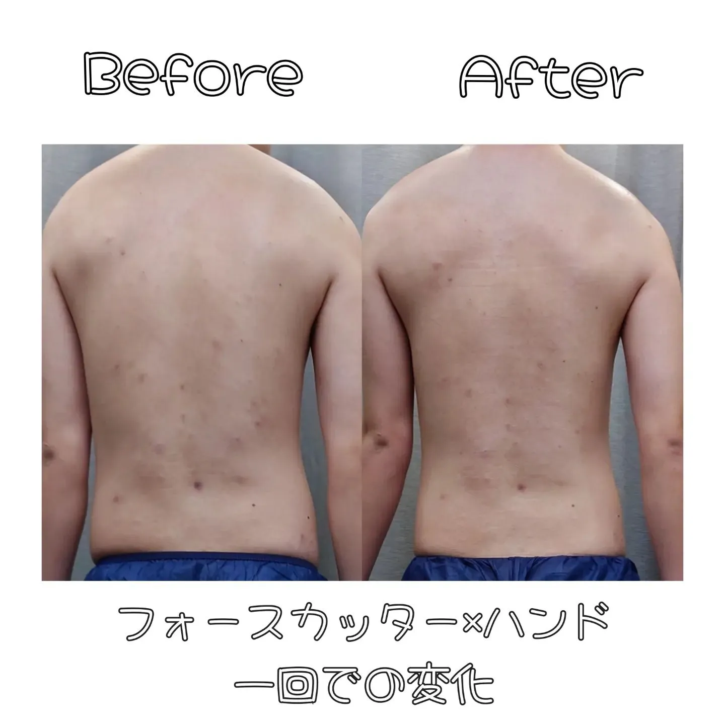 【BeforeAfter】新宿痩身ならエステサロンcocor...