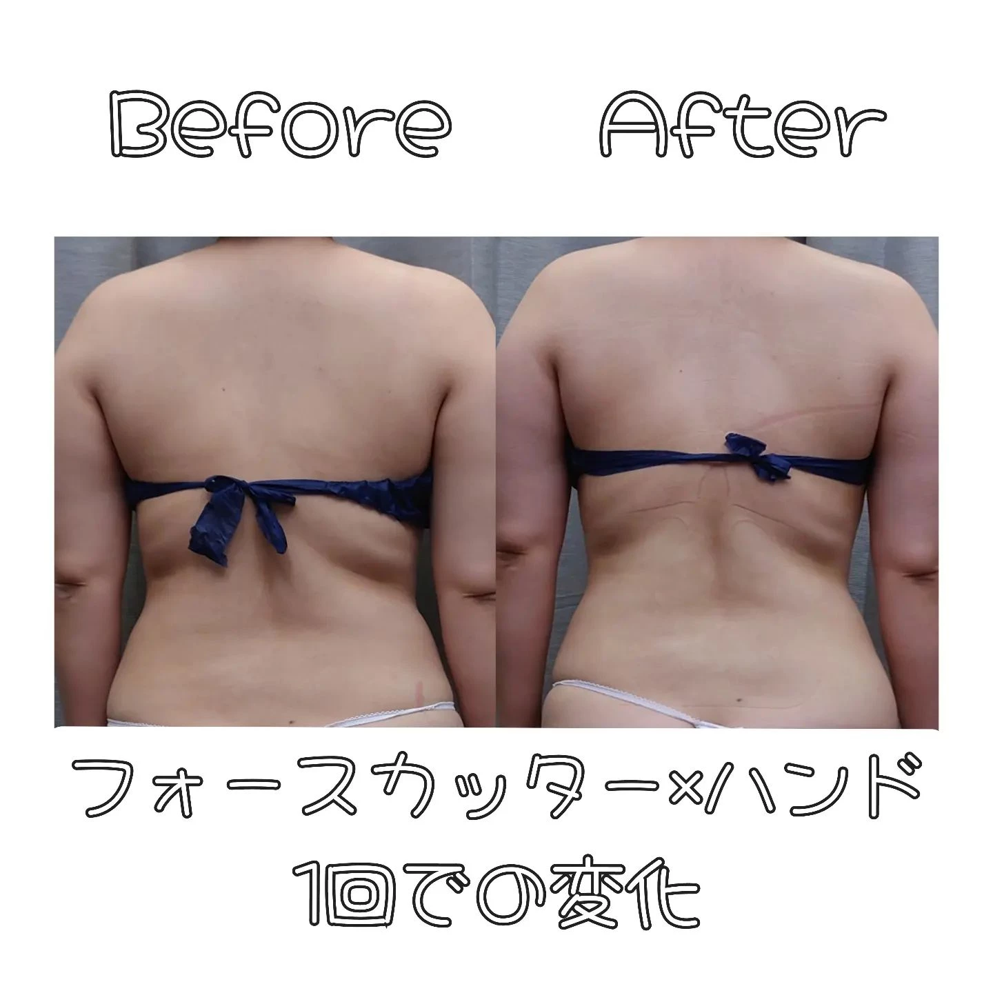 【全身セルライト燃焼コース、1回での変化】新宿痩身ならエステ...