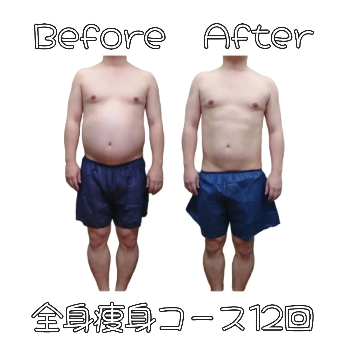 【セルライト脂肪燃焼コース12回の変化】新宿痩身ならエステサ...